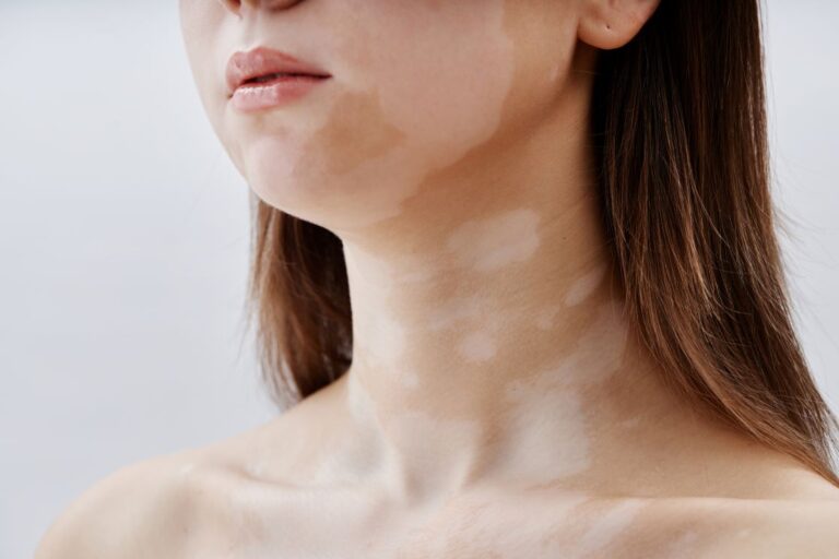 Vitiligo: informação, cuidado e tratamento sob medida
